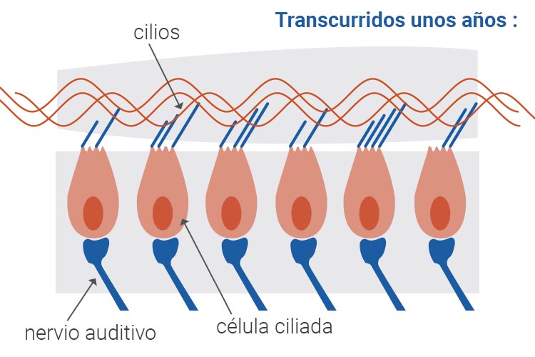 Célula ciliada dañada